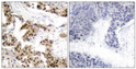Immunohistochemistry analysis of paraffin-embedded human breast carcinoma, using NF-kappaB p105/p50 (Phospho-Ser893) Antibody. The picture on the right is blocked with the phospho peptide.