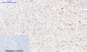 Immunohistochemical analysis of paraffin-embedded Human-uterus-cancer tissue. 1, NF Kappa B-p65 (phospho Ser536) Polyclonal Antibody was diluted at 1:200 (4°C, overnight). 2, Sodium citrate pH 6.0 was used for antibody retrieval (>98°C, 20min). 3, Secondary antibody was diluted at 1:200 (room tempeRature, 30min). Negative control was used by secondary antibody only.