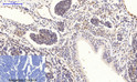 Immunohistochemical analysis of paraffin-embedded Human-lung-cancer tissue. 1, NF Kappa B-p65 (phospho Ser536) Polyclonal Antibody was diluted at 1:200 (4°C, overnight). 2, Sodium citrate pH 6.0 was used for antibody retrieval (>98°C, 20min). 3, Secondary antibody was diluted at 1:200 (room tempeRature, 30min). Negative control was used by secondary antibody only.