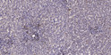 Immunohistochemical analysis of paraffin-embedded human liver cancer. 1, Antibody was diluted at 1:200 (4° overnight). STJ90373