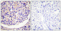 Immunohistochemical analysis of paraffin-embedded Human breast cancer. Antibody was diluted at 1:100 (4°C overnight). High-pressure and temperature Tris-EDTA, pH8.0 was used for antigen retrieval. Negetive contrl (right) obtaned from antibody was pre-absorbed by immunogen peptide.