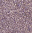 Immunohistochemical analysis of paraffin-embedded human moderately differentiated hepatocellular carcinoma. Antibody STJ90385