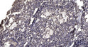 Immunohistochemical analysis of paraffin-embedded human gastric adenocarcinoma. 1, Antibody was diluted at 1:200 (4° STJ90403