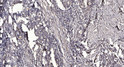Immunohistochemical analysis of paraffin-embedded human gastric adenocarcinoma. 1, Antibody was diluted at 1:200 (4° STJ90405