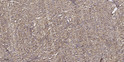 Immunohistochemical analysis of paraffin-embedded human small intestinal carcinoma tissue. 1, Primary antibody was STJ90436