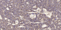 Immunohistochemical analysis of paraffin-embedded human liver cancer. 1, Antibody was diluted at 1:200 (4°C overnight). STJ90469