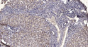 Immunohistochemical analysis of paraffin-embedded human liver cancer. 1, Antibody was diluted at 1:200 (4° overnight). STJ90481