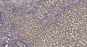 Immunohistochemical analysis of paraffin-embedded human liver cancer. 1, Antibody was diluted at 1:200 (4°C overnight). STJ90486