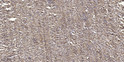 Immunohistochemical analysis of paraffin-embedded human small intestinal carcinoma tissue. 1, Primary antibody was STJ90492