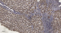 Immunohistochemical analysis of paraffin-embedded human liver cancer. 1, Antibody was diluted at 1:200 (4° overnight). STJ90500