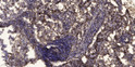Immunohistochemical analysis of paraffin-embedded human squamous cell carcinoma of lung. 1, Antibody was diluted at STJ90513
