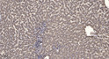Immunohistochemical analysis of paraffin-embedded human liver cancer. 1, Antibody was diluted at 1:200 (4° overnight). STJ90531