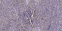 Immunohistochemical analysis of paraffin-embedded human colon cancer. 1, Antibody was diluted at 1:200 (4° overnight). STJ90533