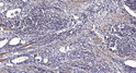 Immunohistochemical analysis of paraffin-embedded human gastric adenocarcinoma. 1, Antibody was diluted at 1:200 (4° STJ90534