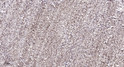 Immunohistochemical analysis of paraffin-embedded human colon cancer. 1, Antibody was diluted at 1:200 (4° overnight). STJ90551