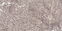 Immunohistochemical analysis of paraffin-embedded human small intestinal carcinoma tissue. 1, Primary antibody was STJ90600
