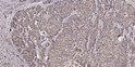 Immunohistochemical analysis of paraffin-embedded human liver cancer. 1, Antibody was diluted at 1:200 (4°C overnight). STJ90634
