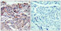 Immunohistochemistry analysis of paraffin-embedded human breast carcinoma, using JAK2 (Phospho-Tyr221) Antibody. The picture on the right is blocked with the phospho peptide. Immunohistochemistry analysis of paraffin-embedded human breast carcinoma, using JAK2 (Phospho-Tyr221) Antibody. The picture on the right is blocked with the phospho peptide.