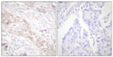 Immunohistochemistry analysis of paraffin-embedded human breast carcinoma, using Smad2 (Phospho-Ser467) Antibody. The picture on the right is blocked with the phospho peptide.