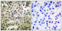 Immunohistochemical analysis of paraffin-embedded Human breast cancer. Antibody was diluted at 1:100 (4°C overnight). High-pressure and temperature Tris-EDTA, pH8.0 was used for antigen retrieval. Negetive contrl (right) obtaned from antibody was pre-absorbed by immunogen peptide.