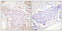 Immunohistochemical analysis of paraffin-embedded Human breast cancer. Antibody was diluted at 1:100 (4°C overnight). High-pressure and temperature Tris-EDTA, pH8.0 was used for antigen retrieval. Negetive contrl (right) obtaned from antibody was pre-absorbed by immunogen peptide.
