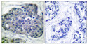 Immunohistochemistry analysis of paraffin-embedded human breast carcinoma, using Acetyl-CoA Carboxylase (Phospho-Ser80) Antibody. The picture on the right is blocked with the phospho peptide.