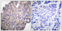 Immunohistochemistry analysis of paraffin-embedded human breast carcinoma, using PLCG1 (Phospho-Tyr771) Antibody. The picture on the right is blocked with the phospho peptide.
