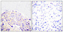 Immunohistochemical analysis of paraffin-embedded Human breast cancer. Antibody was diluted at 1:100 (4°C overnight). High-pressure and temperature Tris-EDTA, pH8.0 was used for antigen retrieval. Negetive contrl (right) obtaned from antibody was pre-absorbed by immunogen peptide.