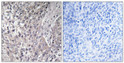 Immunohistochemistry analysis of paraffin-embedded human breast cancer, using VASP (Phospho-Ser157) Antibody. The picture on the right is blocked with the VASP (Phospho-Ser157) peptide.
