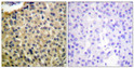 Immunohistochemistry analysis of paraffin-embedded human breast carcinoma, using KIT (Phospho-Tyr703) Antibody. The picture on the right is blocked with the phospho peptide.