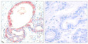 Immunohistochemistry analysis of paraffin-embedded human breast carcinoma, using Rel (Phospho-Ser503) Antibody. The picture on the right is blocked with the phospho peptide.