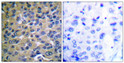 Immunohistochemistry analysis of paraffin-embedded human breast carcinoma, using IkappaB-epsilon (Phospho-Ser22) Antibody. The picture on the right is blocked with the phospho peptide.