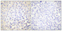Immunohistochemical analysis of paraffin-embedded Human breast cancer. Antibody was diluted at 1:100 (4°C overnight). High-pressure and temperature Tris-EDTA, pH8.0 was used for antigen retrieval. Negetive contrl (right) obtaned from antibody was pre-absorbed by immunogen peptide.