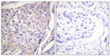 Immunohistochemistry analysis of paraffin-embedded human breast carcinoma, using p70 S6 Kinase (Phospho-Ser418) Antibody. The picture on the right is blocked with the phospho peptide.