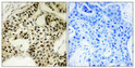 Immunohistochemical analysis of paraffin-embedded Human breast cancer. Antibody was diluted at 1:100 (4°C overnight). High-pressure and temperature Tris-EDTA, pH8.0 was used for antigen retrieval. Negetive contrl (right) obtaned from antibody was pre-absorbed by immunogen peptide.