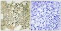 Immunohistochemistry analysis of paraffin-embedded human breast carcinoma, using MYT1 (Phospho-Ser83) Antibody. The picture on the right is blocked with the phospho peptide.