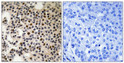 Immunohistochemistry analysis of paraffin-embedded human breast carcinoma, using PAK2 (Phospho-Ser197) Antibody. The picture on the right is blocked with the phospho peptide.