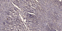 Immunohistochemical analysis of paraffin-embedded human Colon cancer. 1, Antibody was diluted at 1:200 (4°C overnight). 2, Tris-EDTA, pH9.0 was used for antigen retrieval. 3, Secondary antibody was diluted at 1:200 (room temperature, 45min).