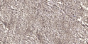 Immunohistochemical analysis of paraffin-embedded human small intestinal carcinoma tissue. 1, Primary antibody was STJ91266