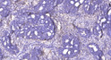 Immunohistochemical analysis of paraffin-embedded human cervical carcinoma. 1, Antibody was diluted at 1:200 (4°C STJ91344