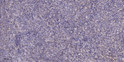 Immunohistochemical analysis of paraffin-embedded human colon cancer. 1, Antibody was diluted at 1:200 (4° overnight). STJ91524