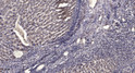 Immunohistochemical analysis of paraffin-embedded human liver cancer. 1, Antibody was diluted at 1:200 (4° overnight). STJ91553