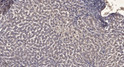 Immunohistochemical analysis of paraffin-embedded human liver cancer. 1, Antibody was diluted at 1:200 (4°C overnight). 2, Tris-EDTA, pH9.0 was used for antigen retrieval. 3, Secondary antibody was diluted at 1:200 (room temperature, 45min).