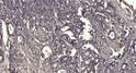 Immunohistochemical analysis of paraffin-embedded human gastric adenocarcinoma. 1, Antibody was diluted at 1:200 (4° STJ91706