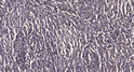 Immunohistochemical analysis of paraffin-embedded human brain tumor. 1, Antibody was diluted at 1:200 (4° overnight). STJ91709