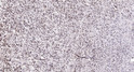Immunohistochemical analysis of paraffin-embedded human colon cancer. 1, Antibody was diluted at 1:200 (4° overnight). STJ91804