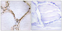 Immunohistochemistry analysis of paraffin-embedded human thyroid gland tissue, using ETK Antibody. The picture on the right is blocked with the synthesized peptide.