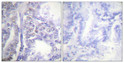 Immunohistochemical analysis of paraffin-embedded Human lung cancer. Antibody was diluted at 1:100 (4°C overnight). High-pressure and temperature Tris-EDTA, pH8.0 was used for antigen retrieval. Negetive contrl (right) obtaned from antibody was pre-absorbed by immunogen peptide.