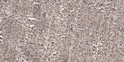Immunohistochemical analysis of paraffin-embedded human small intestinal carcinoma tissue. 1, Primary antibody was STJ91953