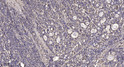 Immunohistochemical analysis of paraffin-embedded human gastric adenocarcinoma. 1, Antibody was diluted at 1:200 (4°C STJ92012